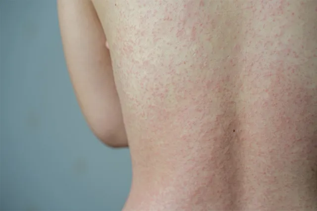 Mẹ Bầu Bị Sởi: 5 Điều Cần Biết Để Bảo Vệ Sức Khỏe Mẹ Bầu